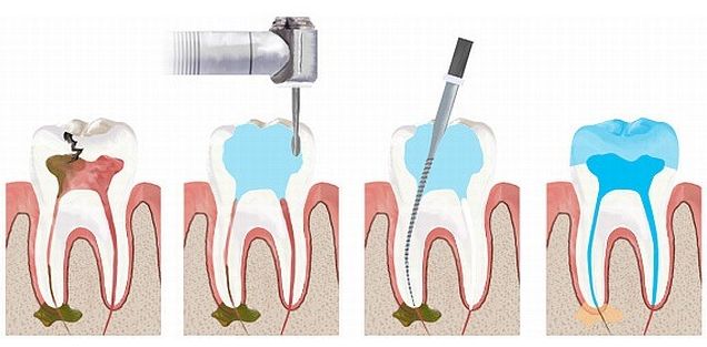 cura canalare montebelluna Studio dentistico Zamprogno