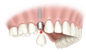 implantologia dentale montebelluna faccetta