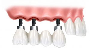 implantologia dentale montebelluna ponte