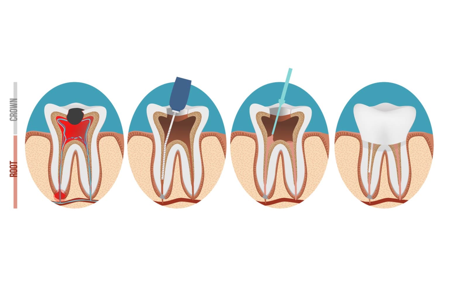 Cure canalari denti